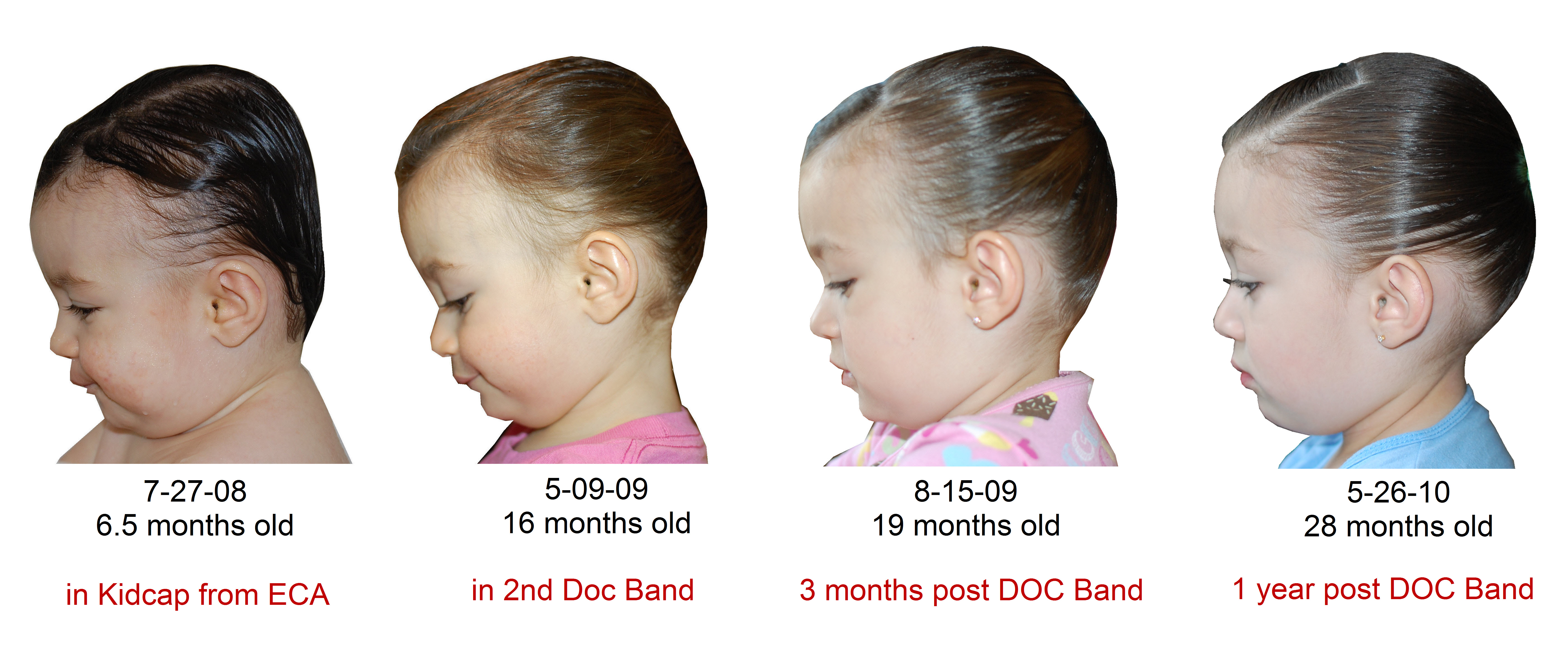 Cranial Technologies - Check out this DOC Band Baby in the arms of